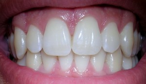 Healthy gums